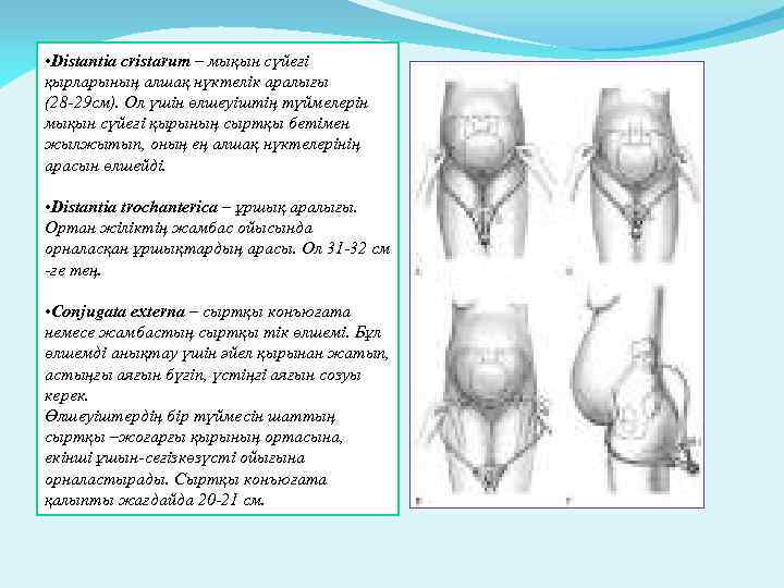  • Distantia cristarum – мықын сүйегі қырларының алшақ нүктелік аралығы (28 -29 см).