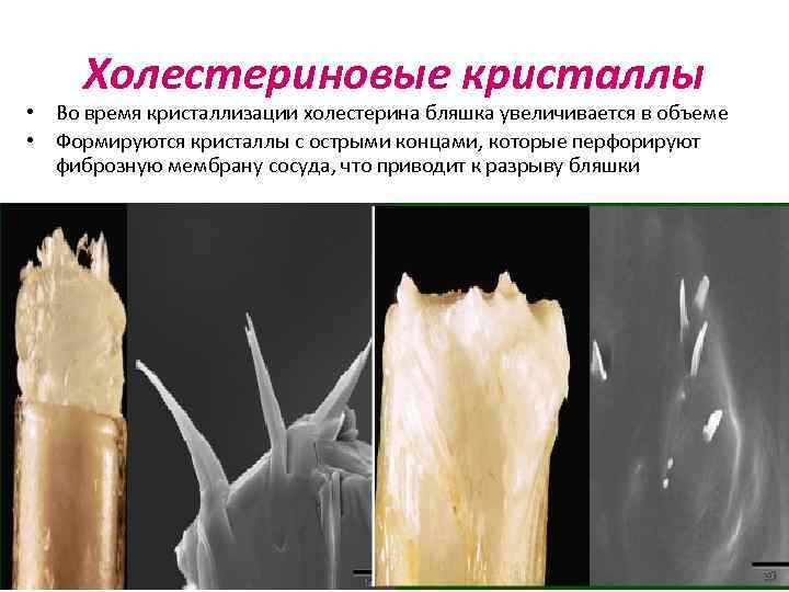 Холестериновые кристаллы • Во время кристаллизации холестерина бляшка увеличивается в объеме • Формируются кристаллы