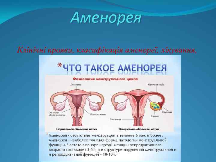 Аменорея Клінічні прояви, класифікація аменореї, лікування, 