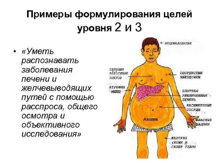 Примеры формулирования целей уровня 2 и 3 • «Уметь распознавать заболевания печени и желчевыводящих