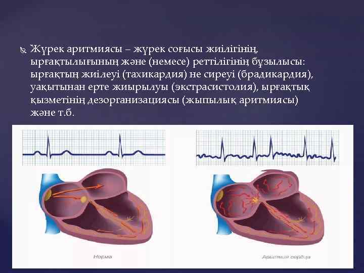  Жүрек аритмиясы – жүрек соғысы жиілігінің, ырғақтылығының және (немесе) реттілігінің бұзылысы: ырғақтың жиілеуі