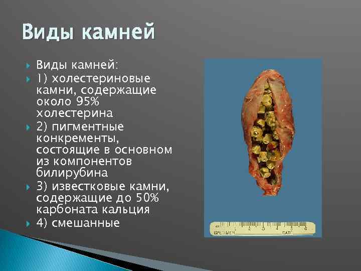 Виды камней Виды камней: 1) холестериновые камни, содержащие около 95% холестерина 2) пигментные конкременты,