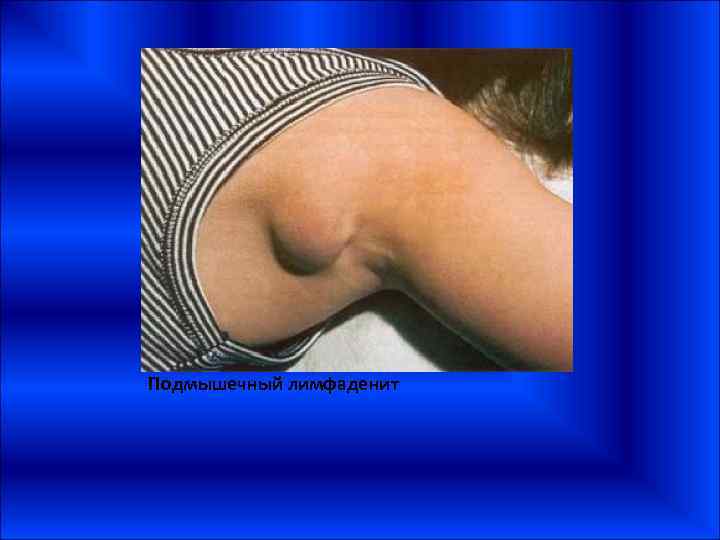 Подмышечный лимфаденит 