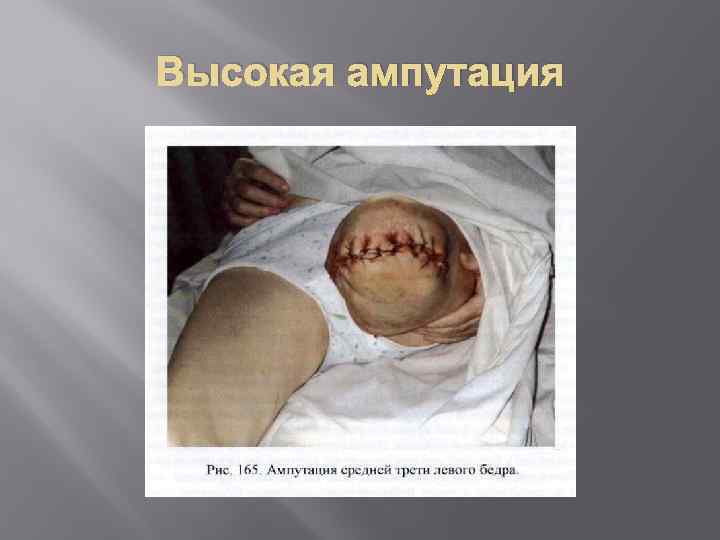 Высокая ампутация 