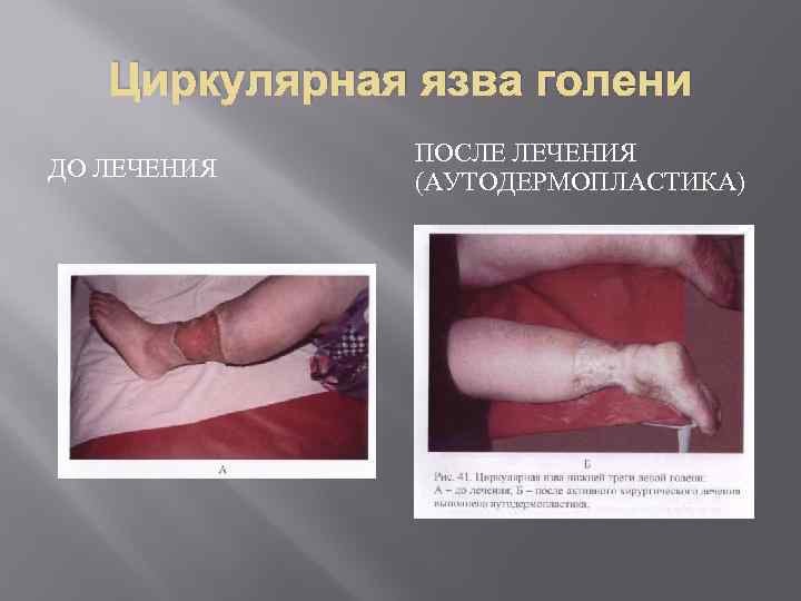 Циркулярная язва голени ДО ЛЕЧЕНИЯ ПОСЛЕ ЛЕЧЕНИЯ (АУТОДЕРМОПЛАСТИКА) 