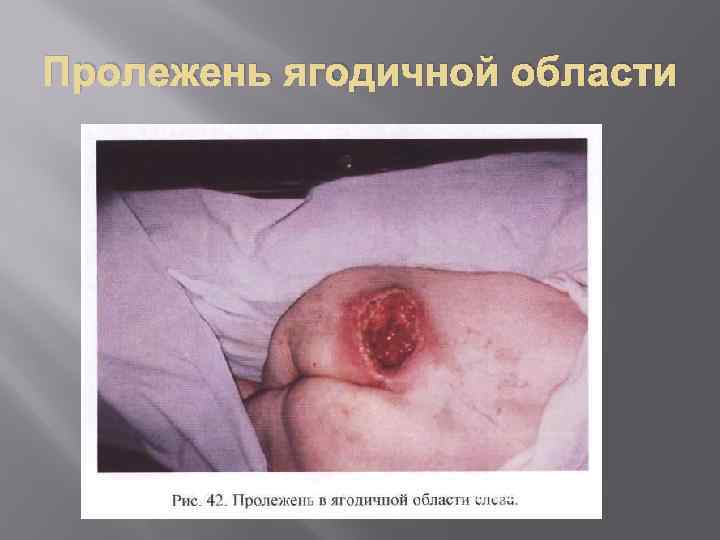 Пролежень ягодичной области 