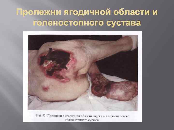 Пролежни ягодичной области и голеностопного сустава 