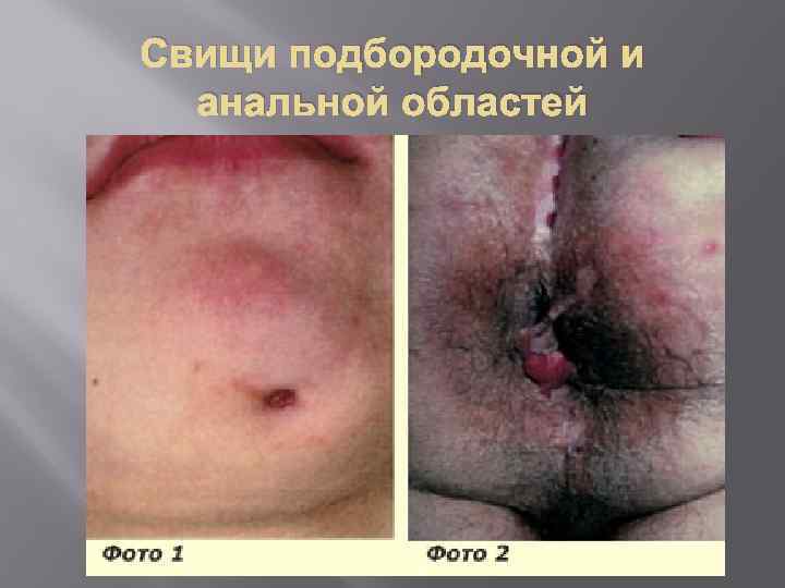 Свищи подбородочной и анальной областей 