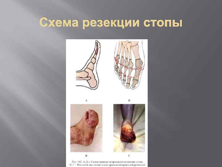 Схема резекции стопы 