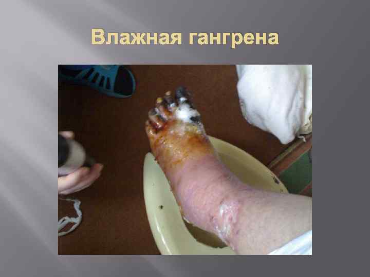 Влажная гангрена 