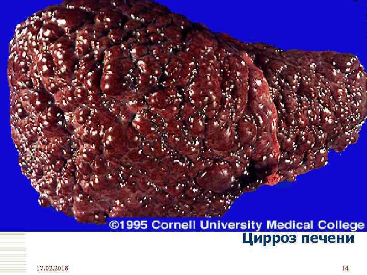 Цирроз печени 17. 02. 2018 14 