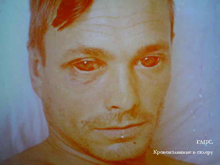 ГЛПС. Кровоизлияние в склеру 