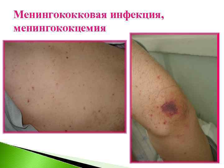 Менингококковая инфекция, менингококцемия 