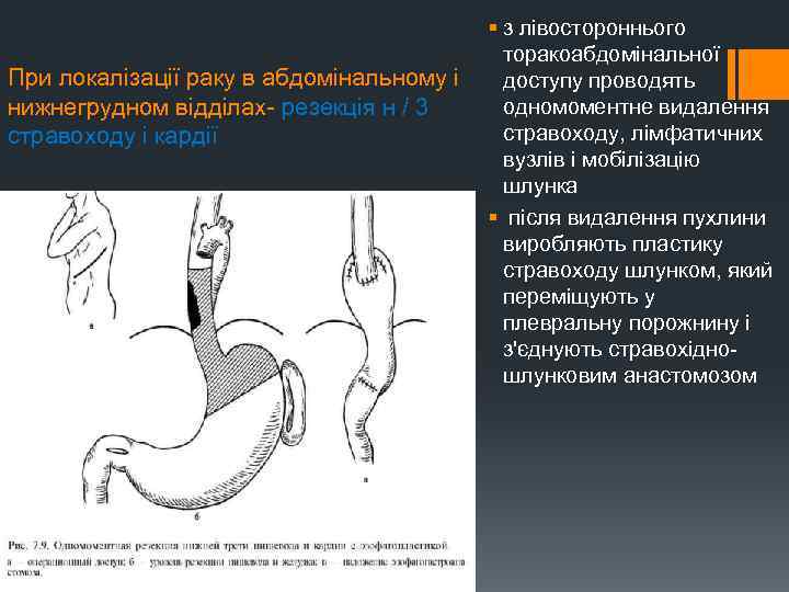 § з лівостороннього торакоабдомінальної При локалізації раку в абдомінальному і доступу проводять одномоментне видалення