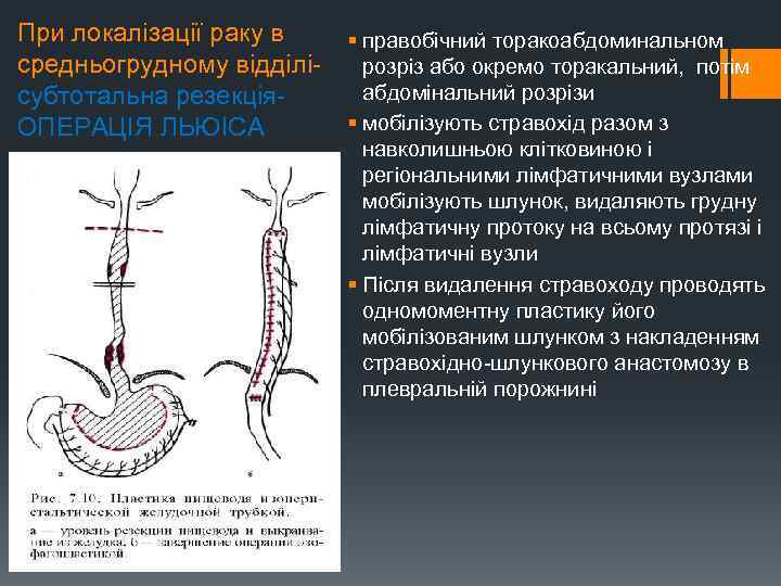 При локалізації раку в § правобічний торакоабдоминальном средньогрудному відділі- розріз або окремо торакальний, потім