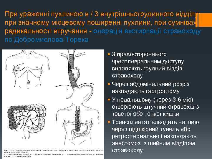 При ураженні пухлиною в / 3 внутрішньогрудинного відділу, при значному місцевому поширенні пухлини, при