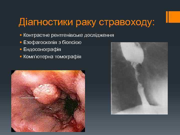 Діагностики раку стравоходу: § Контрастне рентгенівське дослідження § Езофагоскопія з біопсією § Ендосонографія §