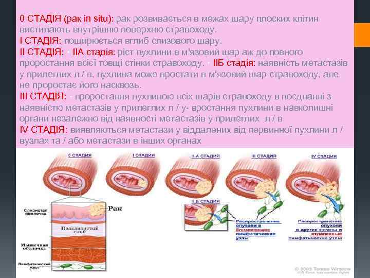 0 СТАДІЯ (рак in situ): рак розвивається в межах шару плоских клітин вистилають внутрішню