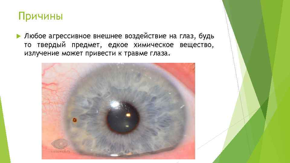 Причины Любое агрессивное внешнее воздействие на глаз, будь то твердый предмет, едкое химическое вещество,