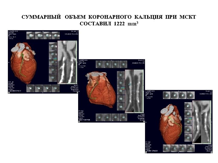 СУММАРНЫЙ ОБЪЕМ КОРОНАРНОГО КАЛЬЦИЯ ПРИ МСКТ СОСТАВИЛ 1222 mm 3 