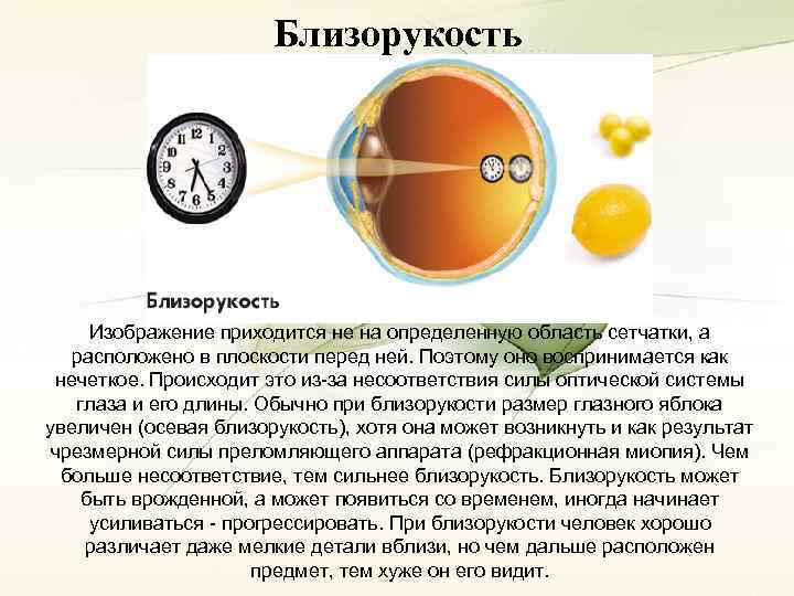 Близорукость Изображение приходится не на определенную область сетчатки, а расположено в плоскости перед ней.