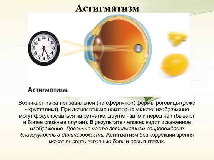 Астигматизм Возникает из-за неправильной (не сферичной) формы роговицы (реже - хрусталика). При астигматизме некоторые