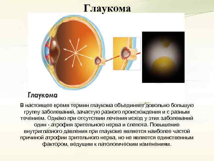 Глаукома В настоящее время термин глаукома объединяет довольно большую группу заболеваний, зачастую разного происхождения