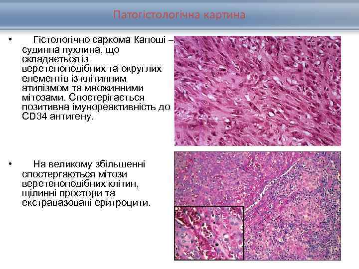 Патогістологічна картина • Гістологічно саркома Капоші – судинна пухлина, що складається із веретеноподібних та