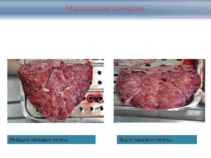 Макроскопові препарати Передня поверхня легень Задня поверхня легень 