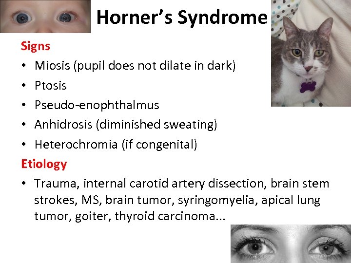 Horner’s Syndrome Signs • Miosis (pupil does not dilate in dark) • Ptosis •