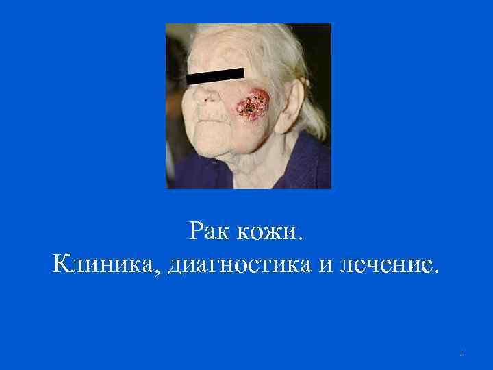 Рак кожи. Клиника, диагностика и лечение. 1 