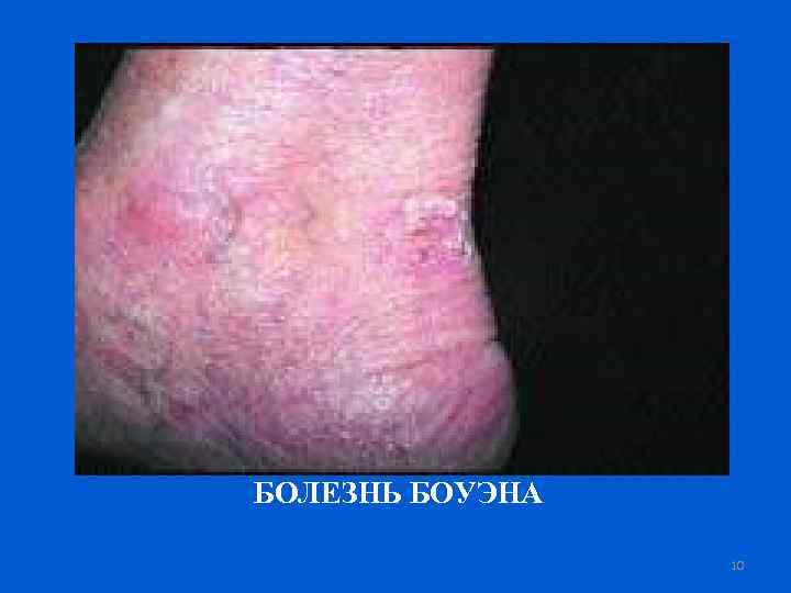 БОЛЕЗНЬ БОУЭНА 10 