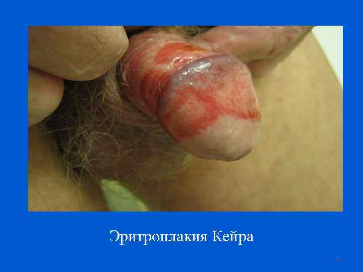 Эритроплакия Кейра 11 