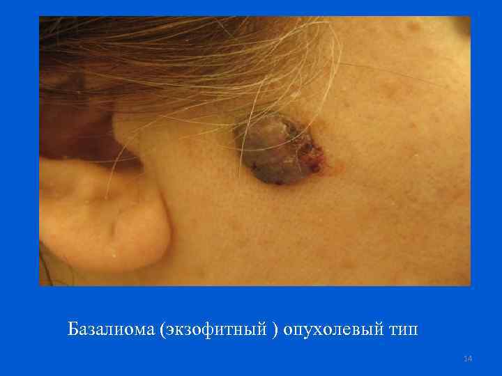 Базалиома (экзофитный ) опухолевый тип 14 