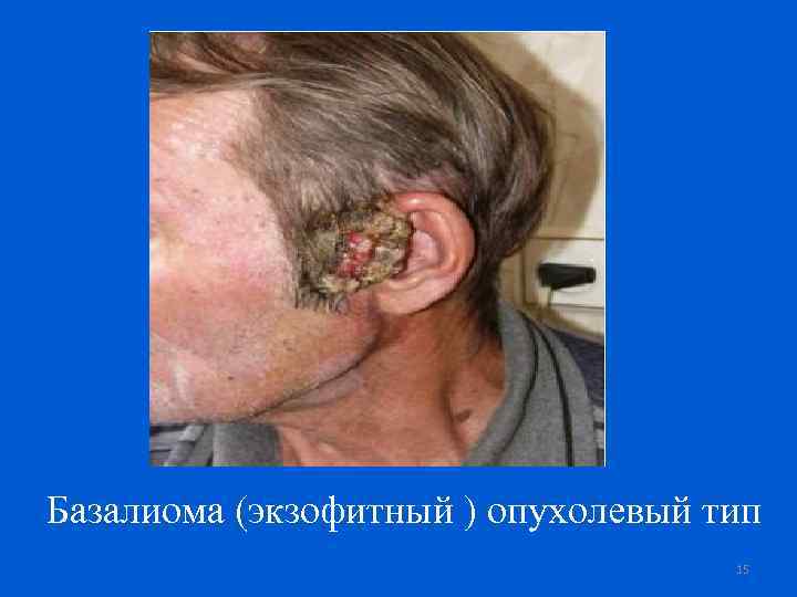 Базалиома (экзофитный ) опухолевый тип 15 