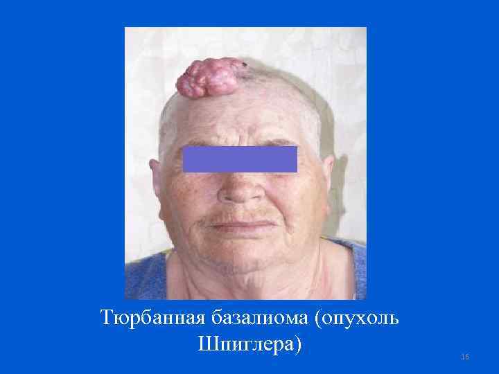 Тюрбанная базалиома (опухоль Шпиглера) 16 