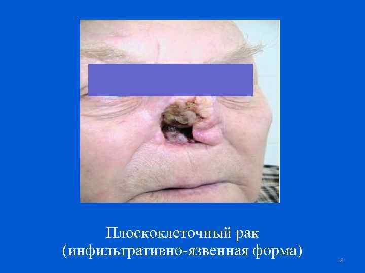 Плоскоклеточный рак (инфильтративно-язвенная форма) 18 