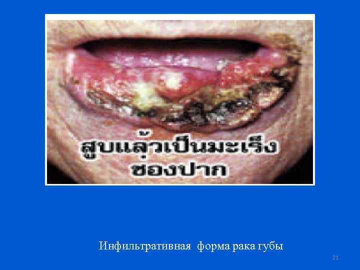 Инфильтративная форма рака губы 21 