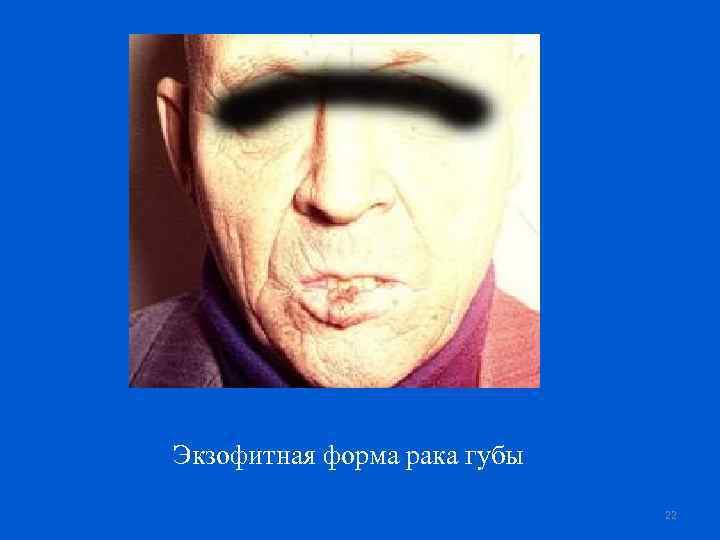 Экзофитная форма рака губы 22 