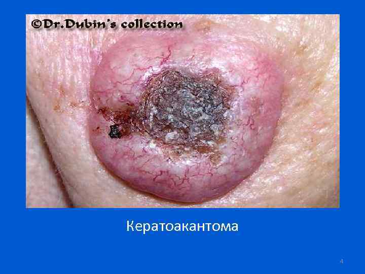 Кератоакантома 4 