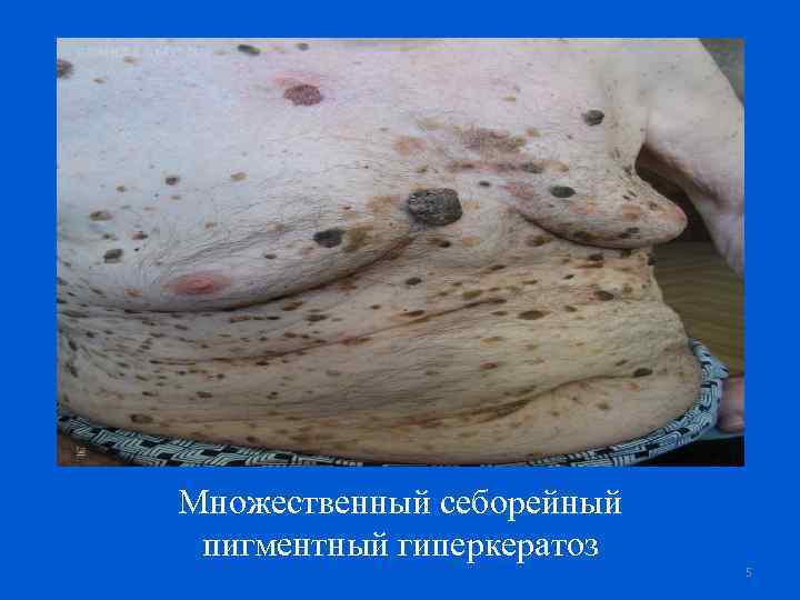 Множественный себорейный пигментный гиперкератоз 5 