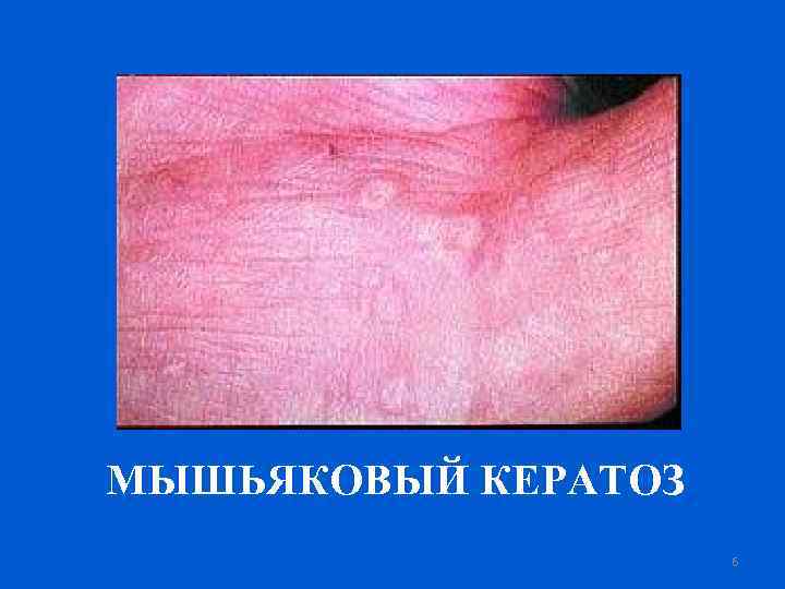 МЫШЬЯКОВЫЙ КЕРАТОЗ 6 