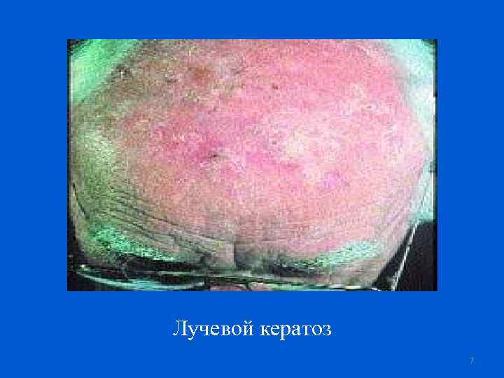 Лучевой кератоз 7 