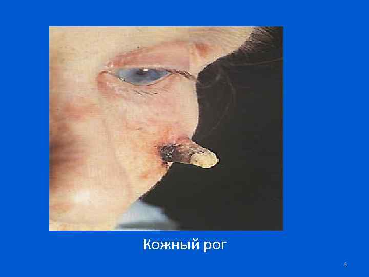 Кожный рог 8 