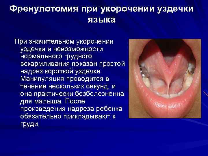 Френулотомия при укорочении уздечки языка При значительном укорочении уздечки и невозможности нормального грудного вскармливания