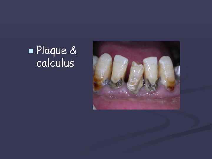 n Plaque & calculus 