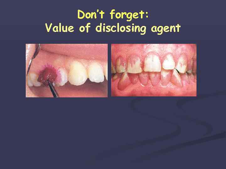 Don’t forget: Value of disclosing agent 