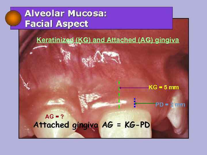 Keratinized (KG) and Attached (AG) gingiva KG = 5 mm PD = 2 mm