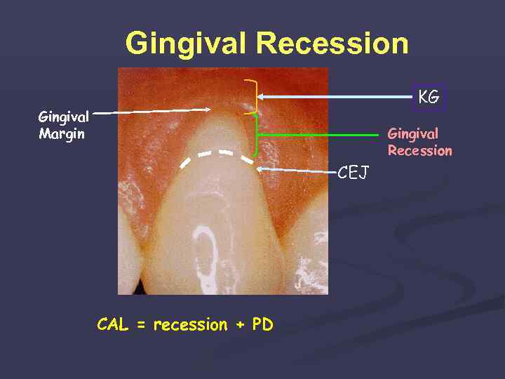Gingival Recession KG Gingival Margin Gingival Recession CEJ CAL = recession + PD 