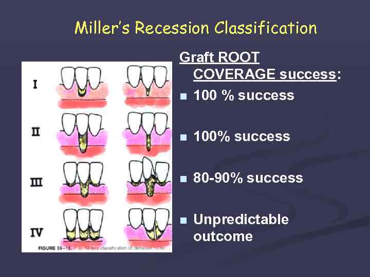 Miller’s Recession Classification Graft ROOT COVERAGE success: n 100 % success n 100% success